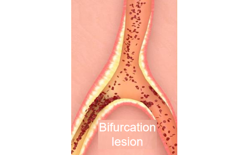or datafanyifanyiSmall Vascular Disease Bifurcation Lesion